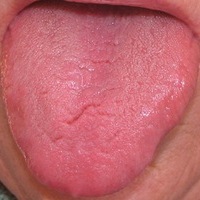 Červený jazyk zde znamená příliš červený a odpovídá horku RE Červený jazyk zde znamená příliš červený a odpovídá horku RE